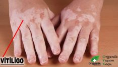 Vitiligo Nedir? Vitiligo için 3 Bitkisel Kür Tarifi